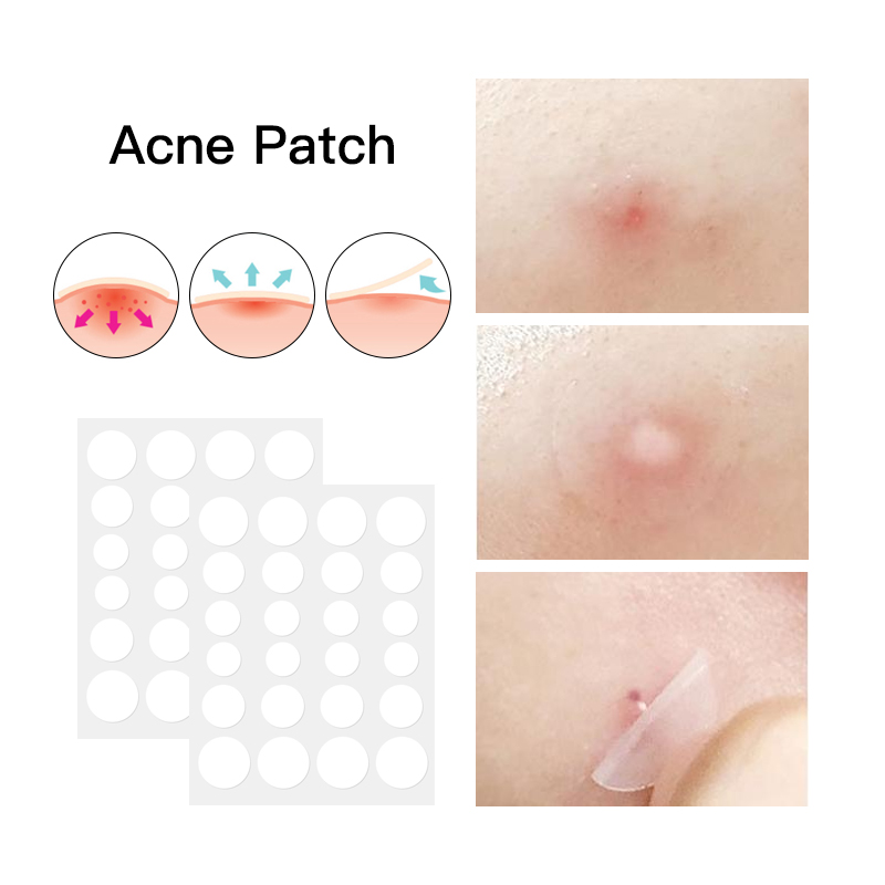 Acne Patch